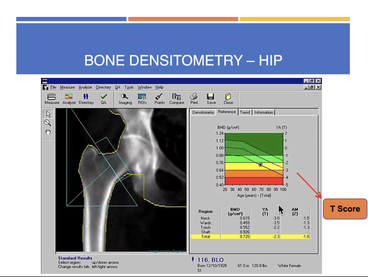 osteoporosis_4 Rumah Sakit Islam Jakarta Cempaka Putih - Web